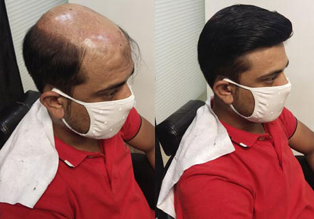 Hair Replacement