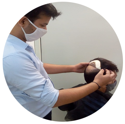Hair Replacement in Delhi